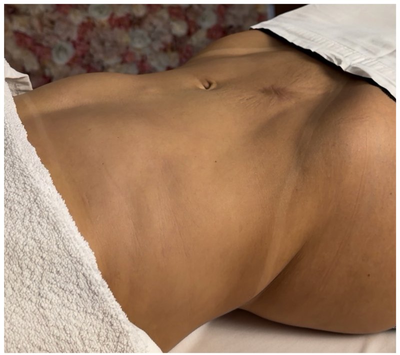 Abdômen antes da sessão de Ultradrenagem Corporal