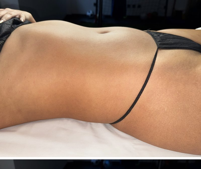 Abdômen antes da sessão de Ultradrenagem